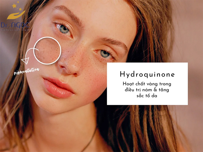 Hydroquienone - sản phẩm vàng trong điều nám và tàn nhang