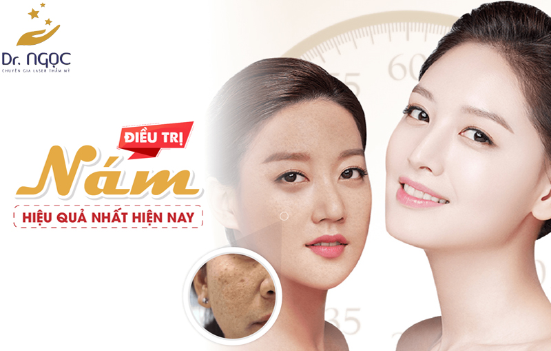 Phương Pháp điều Trị Nám Hiệu Quả Số 1 Trên Thị Trường 2267