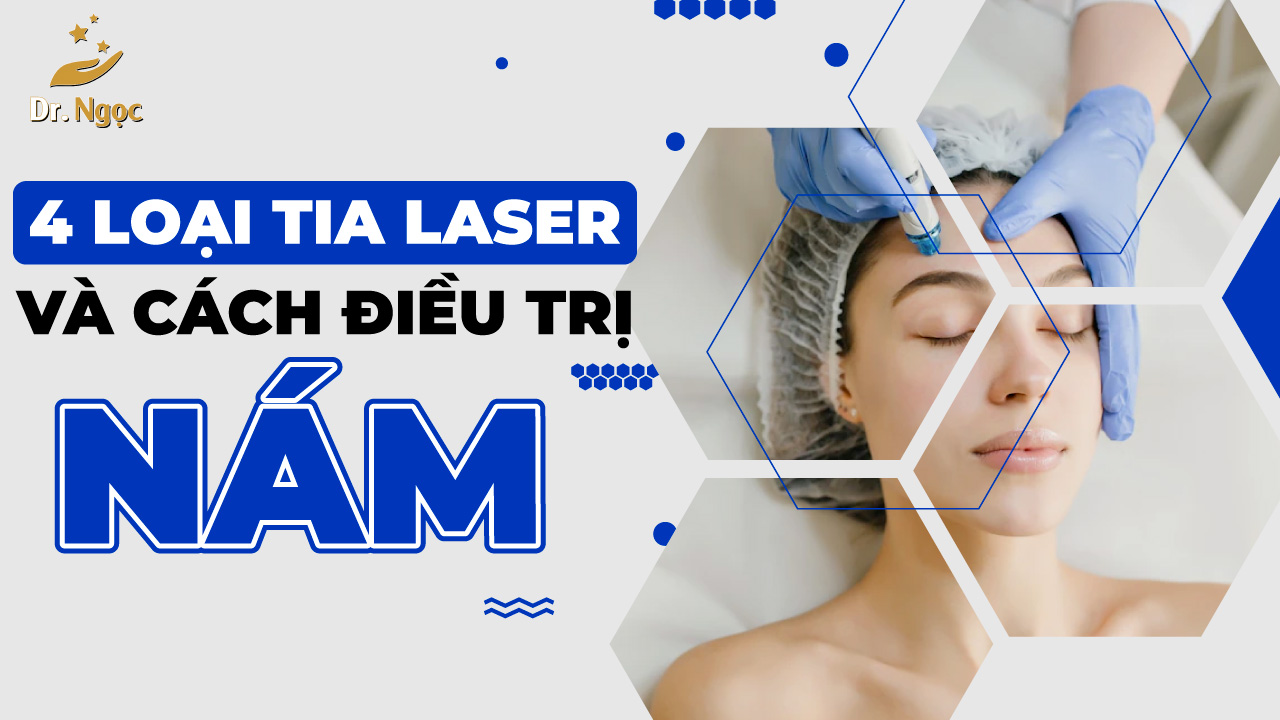 4 loại tia laser và cách điều trị nám bằng laser