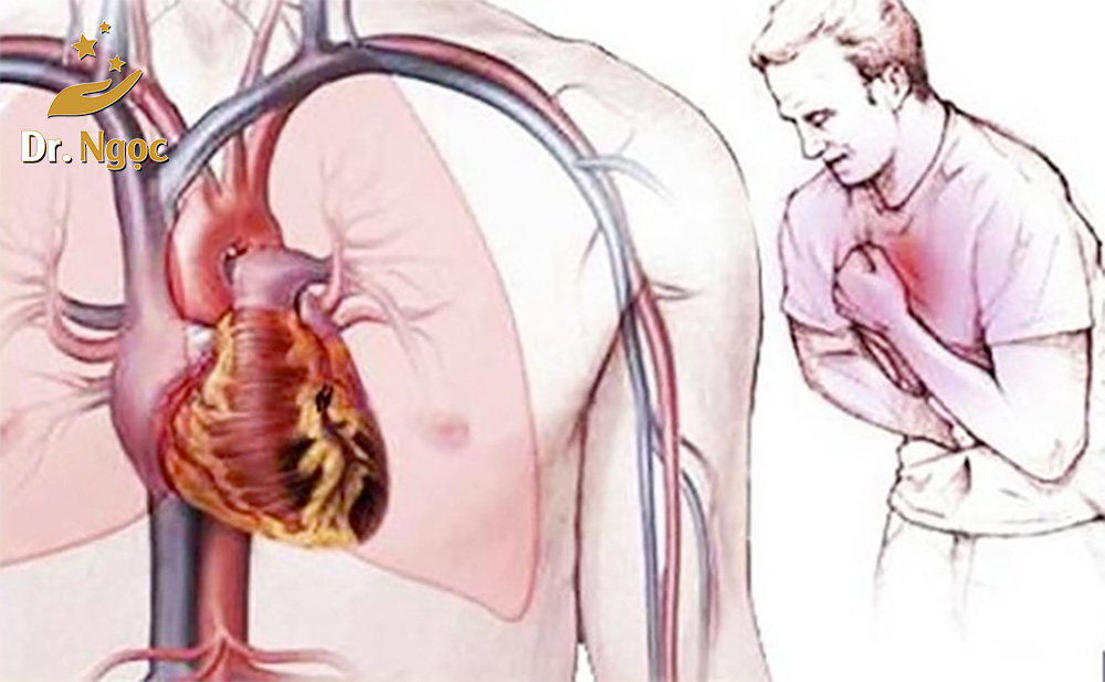 7 loại bệnh tim mạch thường gặp
