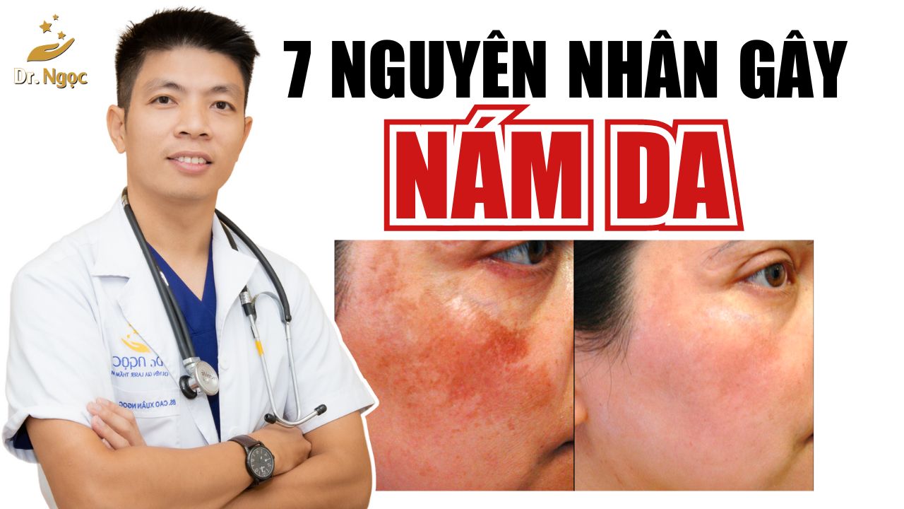 7 nguyên nhân gây nám da: tìm hiểu và phòng tránh Dr Ngọc